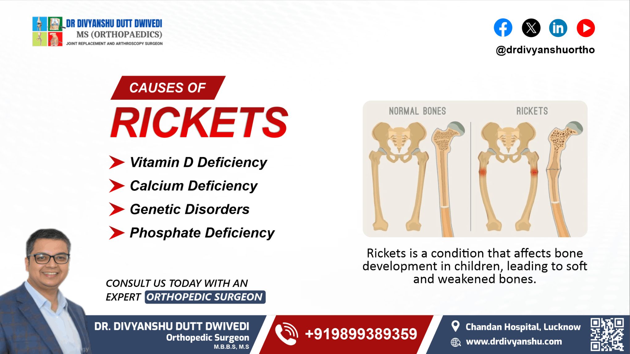 Causes of Rickets Understanding the Key Factors